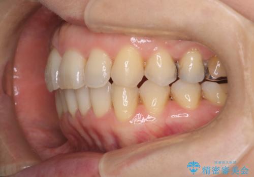 目立たないマウスピースで八重歯を解消。右上5番の抜歯スペースを活用したインビザライン矯正の治療後