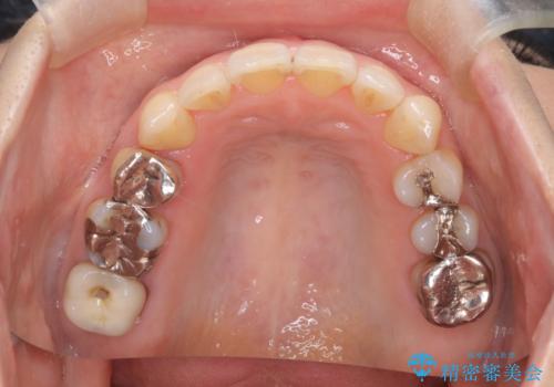 目立たないマウスピースで八重歯を解消。右上5番の抜歯スペースを活用したインビザライン矯正の治療後