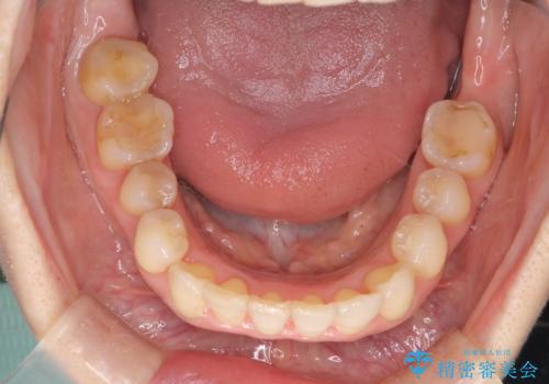 目立たないマウスピースで八重歯を解消。右上5番の抜歯スペースを活用したインビザライン矯正の治療後