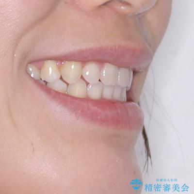 口ゴボが気になる 上下4本の抜歯矯正の治療後(顔貌)