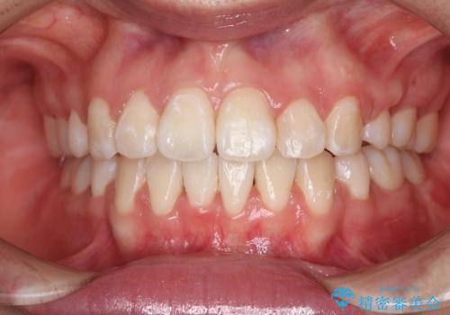 【審美装置】口元を下げたいの治療後