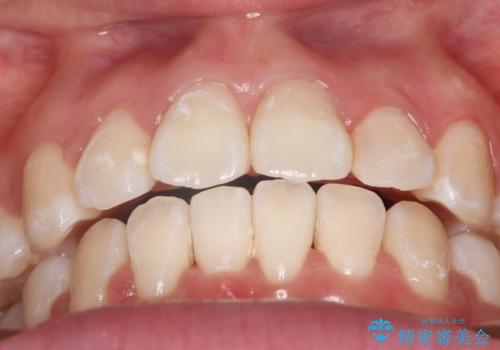 【審美装置】口元を下げたいの治療後