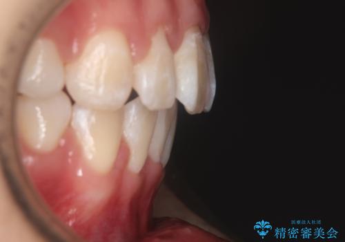 【審美装置】口元を下げたいの治療後