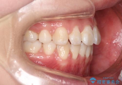 【審美装置】口元を下げたいの治療後