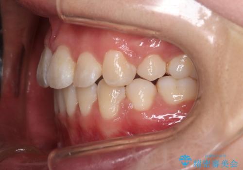 【審美装置】口元を下げたいの治療後