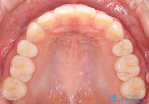 【審美装置】口元を下げたいの治療後