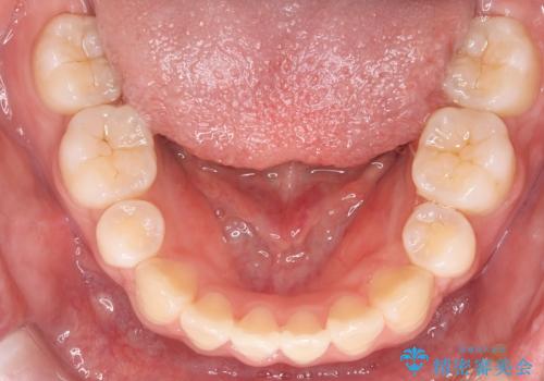 【審美装置】口元を下げたいの治療後