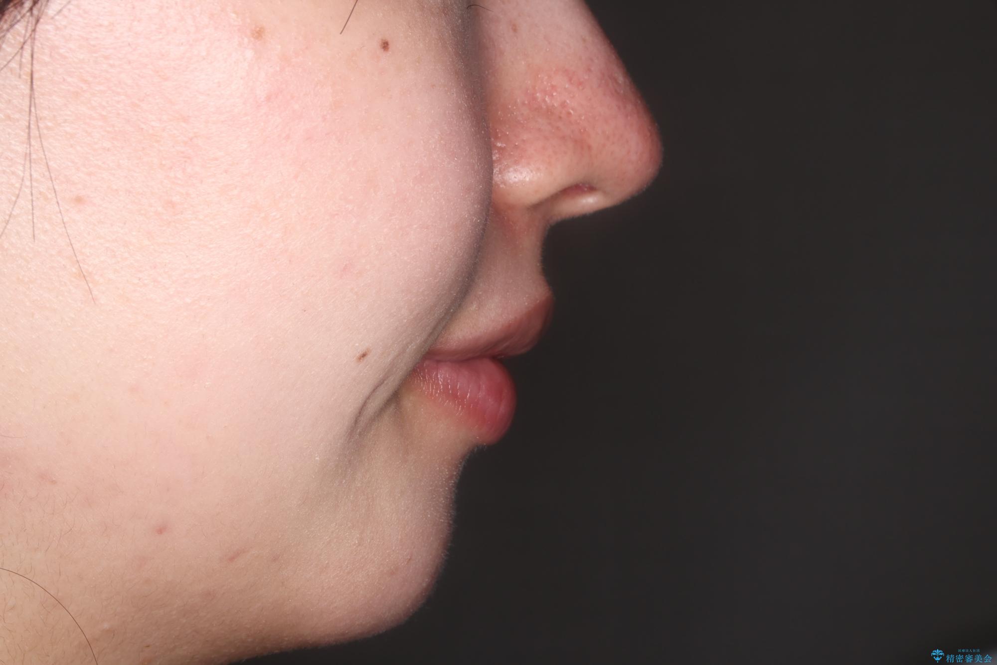 【審美装置】口元を下げたいの治療後(顔貌)