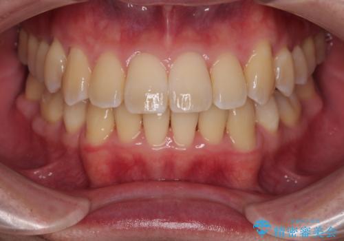 下顎の叢生を抜歯矯正で改善|費用を抑えたメタルブラケット矯正の治療後