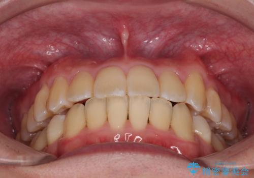 下顎の叢生を抜歯矯正で改善|費用を抑えたメタルブラケット矯正の治療後