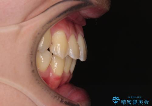 下顎の叢生を抜歯矯正で改善|費用を抑えたメタルブラケット矯正の治療後