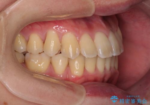 下顎の叢生を抜歯矯正で改善|費用を抑えたメタルブラケット矯正の治療後
