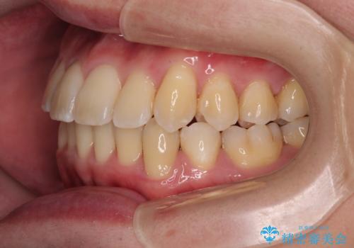 下顎の叢生を抜歯矯正で改善|費用を抑えたメタルブラケット矯正の治療後