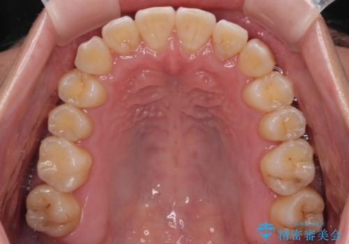 下顎の叢生を抜歯矯正で改善|費用を抑えたメタルブラケット矯正の治療後