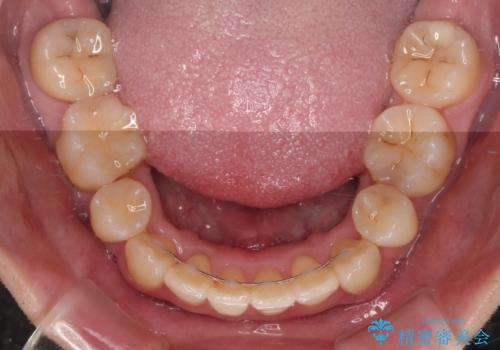 下顎の叢生を抜歯矯正で改善|費用を抑えたメタルブラケット矯正の治療後