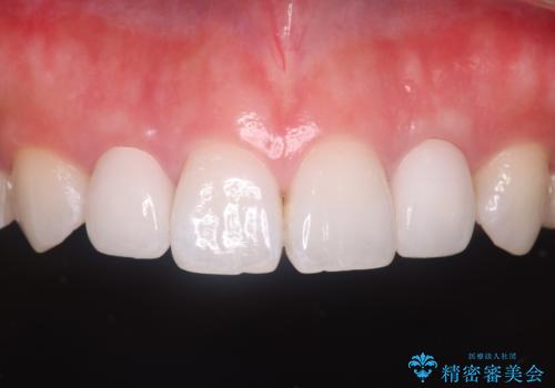 歯に食べ物がはさまる　色も揃えたい　オールセラミックで治療の治療後