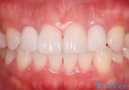 歯に食べ物がはさまる 色も揃えたい オールセラミックで治療の治療後
