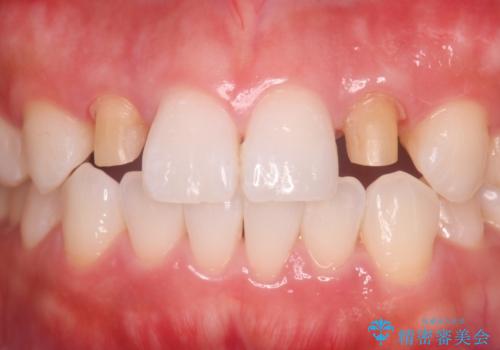 歯に食べ物がはさまる 色も揃えたい オールセラミックで治療の治療中