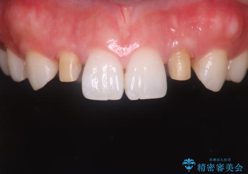 歯に食べ物がはさまる　色も揃えたい　オールセラミックで治療の治療中