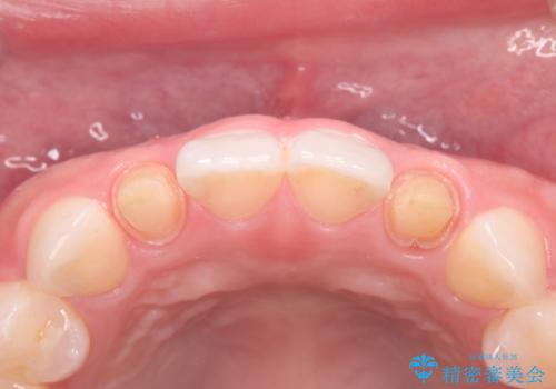 歯に食べ物がはさまる 色も揃えたい オールセラミックで治療の治療中