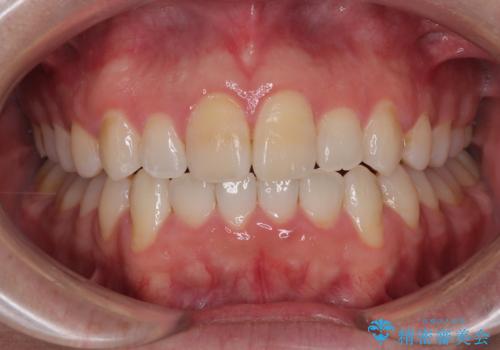 マウスピース矯正と迷った結果…管理のしやすさで選んだクリアブラケット矯正の症例の治療後