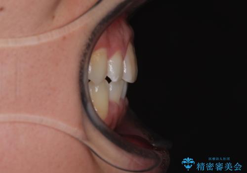 マウスピース矯正と迷った結果…管理のしやすさで選んだクリアブラケット矯正の症例の治療後