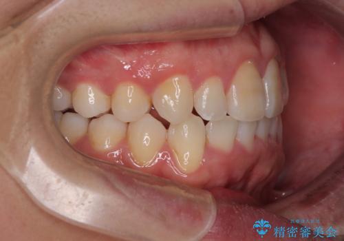 マウスピース矯正と迷った結果…管理のしやすさで選んだクリアブラケット矯正の症例の治療後