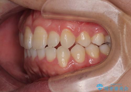 マウスピース矯正と迷った結果…管理のしやすさで選んだクリアブラケット矯正の症例の治療後