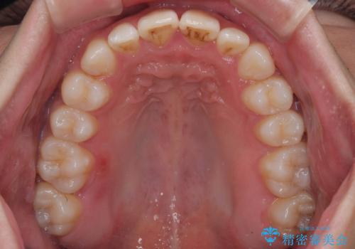 マウスピース矯正と迷った結果…管理のしやすさで選んだクリアブラケット矯正の症例の治療後