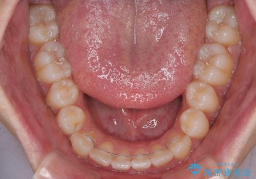 マウスピース矯正と迷った結果…管理のしやすさで選んだクリアブラケット矯正の症例の治療後