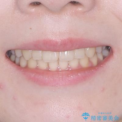 飛び出した前歯を引っ込める ワイヤー装置の非抜歯矯正の治療後(顔貌)