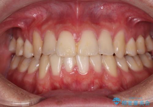 矯正治療の後戻り　インビザライン・モデレートパッケージで短期間治療