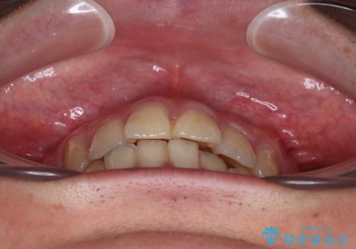 矯正治療の後戻り インビザライン・モデレートパッケージで短期間治療の治療前