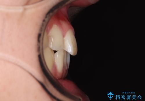 矯正治療の後戻り　インビザライン・モデレートパッケージで短期間治療の治療前