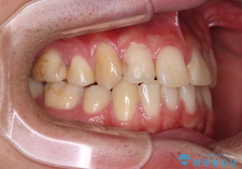 矯正治療の後戻り　インビザライン・モデレートパッケージで短期間治療の治療前