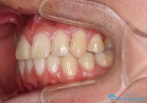 矯正治療の後戻り インビザライン・モデレートパッケージで短期間治療の治療前