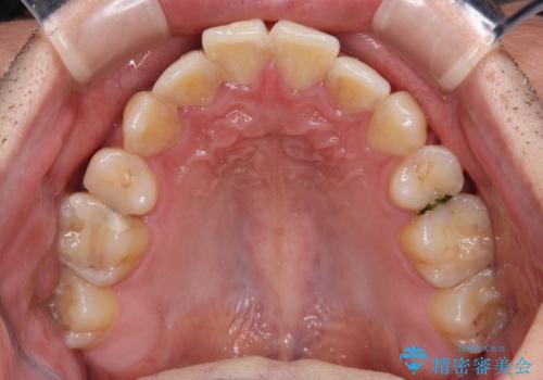 矯正治療の後戻り インビザライン・モデレートパッケージで短期間治療の治療前