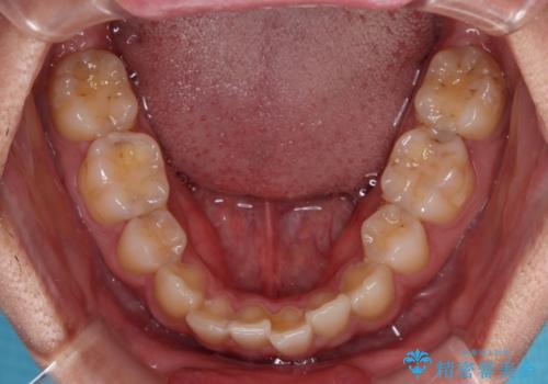 矯正治療の後戻り　インビザライン・モデレートパッケージで短期間治療の治療前