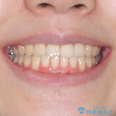 インビザラインの自己管理は煩わしい ワイヤー矯正で短期間矯正治療の治療後(顔貌)