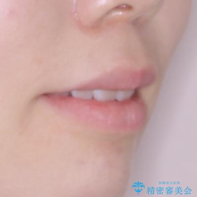 飛び出した前歯を引っ込める ワイヤー装置での抜歯矯正治療の治療後(顔貌)