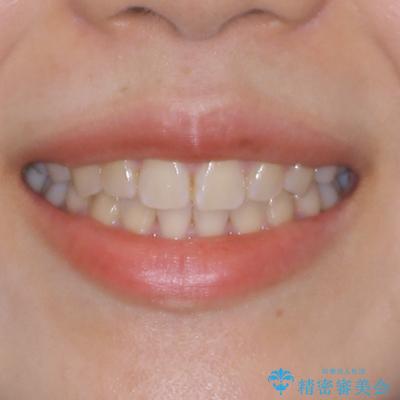 デコボコと捻れて前に飛び出した歯列 抜歯矯正でスッキリした口元にの治療後(顔貌)