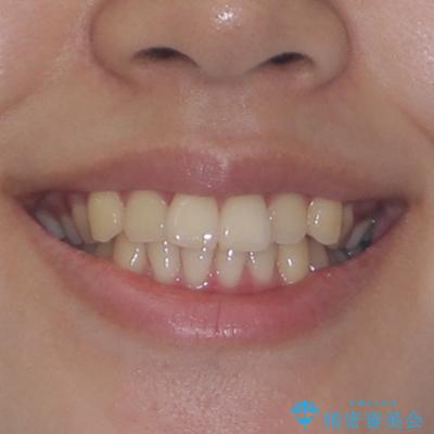 インビザラインの自己管理は煩わしい ワイヤー矯正で短期間矯正治療の治療前(顔貌)