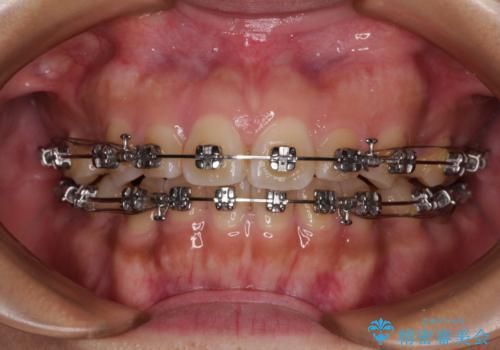 デコボコと捻れて前に飛び出した歯列　抜歯矯正でスッキリした口元にの治療中