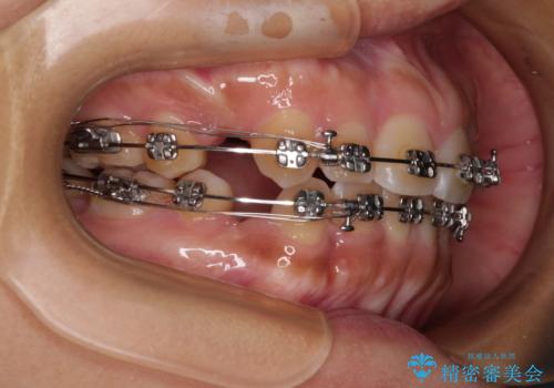 デコボコと捻れて前に飛び出した歯列　抜歯矯正でスッキリした口元にの治療中