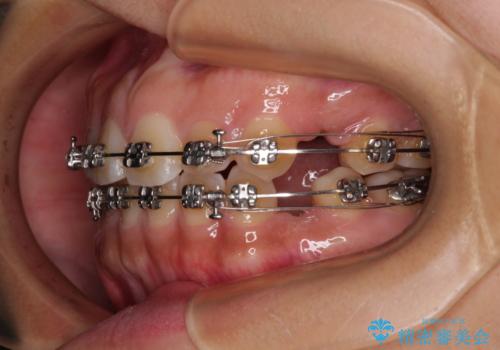 デコボコと捻れて前に飛び出した歯列　抜歯矯正でスッキリした口元にの治療中