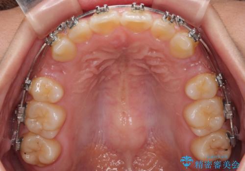 デコボコと捻れて前に飛び出した歯列 抜歯矯正でスッキリした口元にの治療中