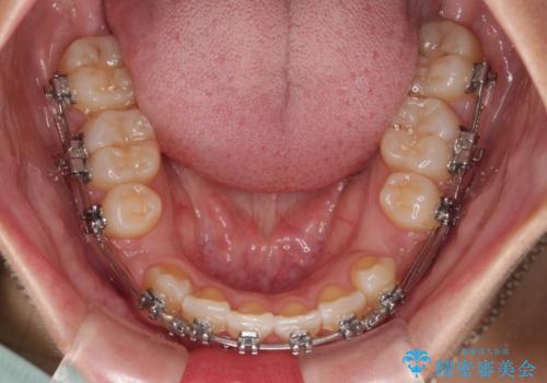 デコボコと捻れて前に飛び出した歯列 抜歯矯正でスッキリした口元にの治療中