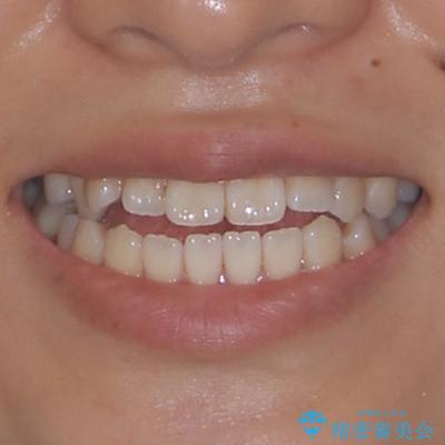 舌の突出癖が原因 インビザライン矯正による開咬改善の治療前(顔貌)