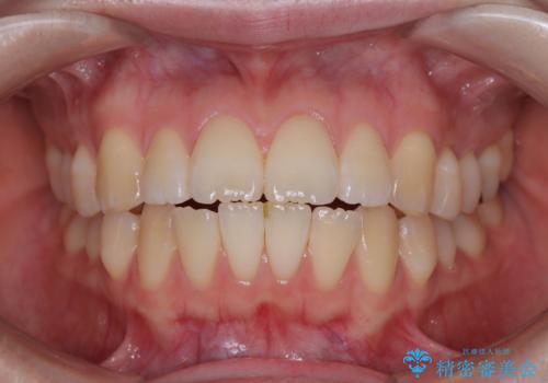 飛び出した前歯を引っ込める　ワイヤー装置での抜歯矯正治療の治療前