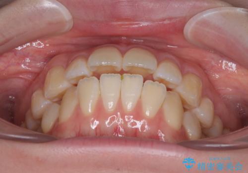 飛び出した前歯を引っ込める ワイヤー装置での抜歯矯正治療の治療前